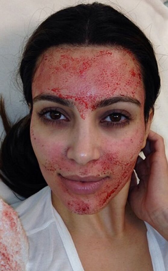 Vampire Facial: Τρεις γυναίκες διαγνώστηκαν με HIV μετά τη θεραπεία