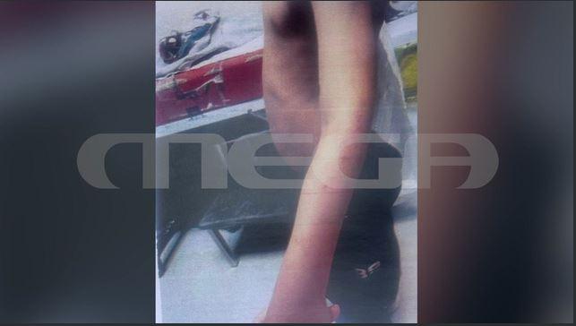 Λάρισα: Φωτογραφίες ντοκουμέντο με τα σημάδια από τα καψίματα στα κορμιά των δύο παιδιών