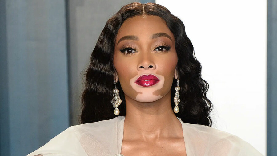 Winnie Harlow: Διακοπές στην Ίμπιζα για το διάσημο μοντέλο
