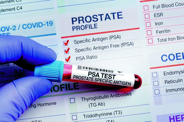 Απίστευτη ανατροπή: Πώς η τεστοστερόνη έγινε σύμμαχος του προστάτη από ύποπτος παράγοντας