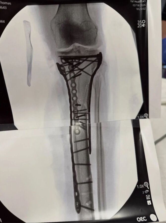 Λίντσεϊ Βον: Τι είναι το «σύνδρομο διαμερίσματος» που απείλησε με ακρωτηριασμό τη θρυλική σκιέρ (vid, pics)