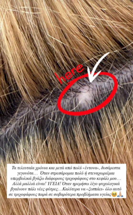 Ιωάννα Τούνη: Το αυτοάνοσο που την ταλαιπωρεί – Τι είναι οι «τριχοφάγοι»