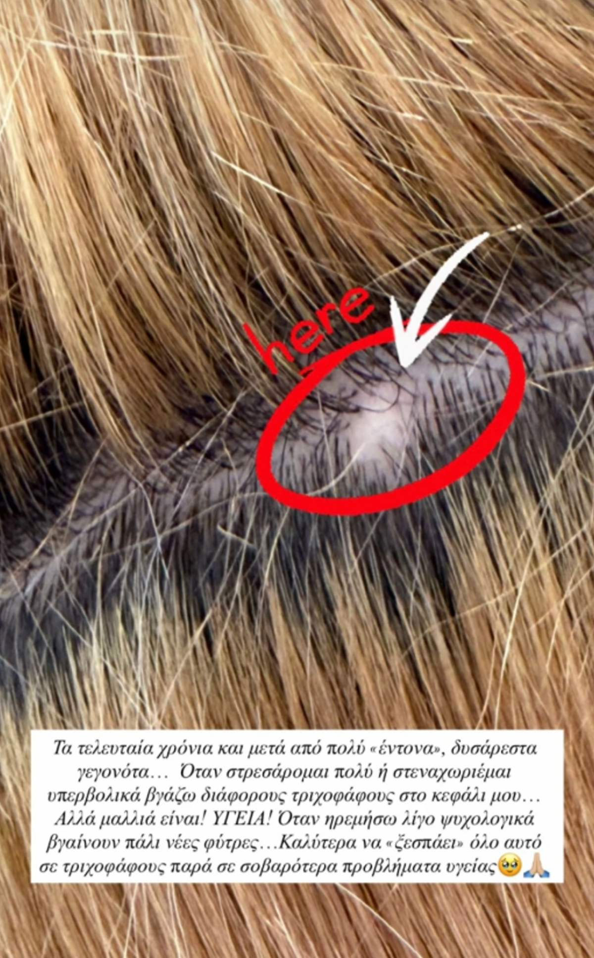 Ιωάννα Τούνη: Το αυτοάνοσο που την ταλαιπωρεί – Τι είναι οι «τριχοφάγοι»