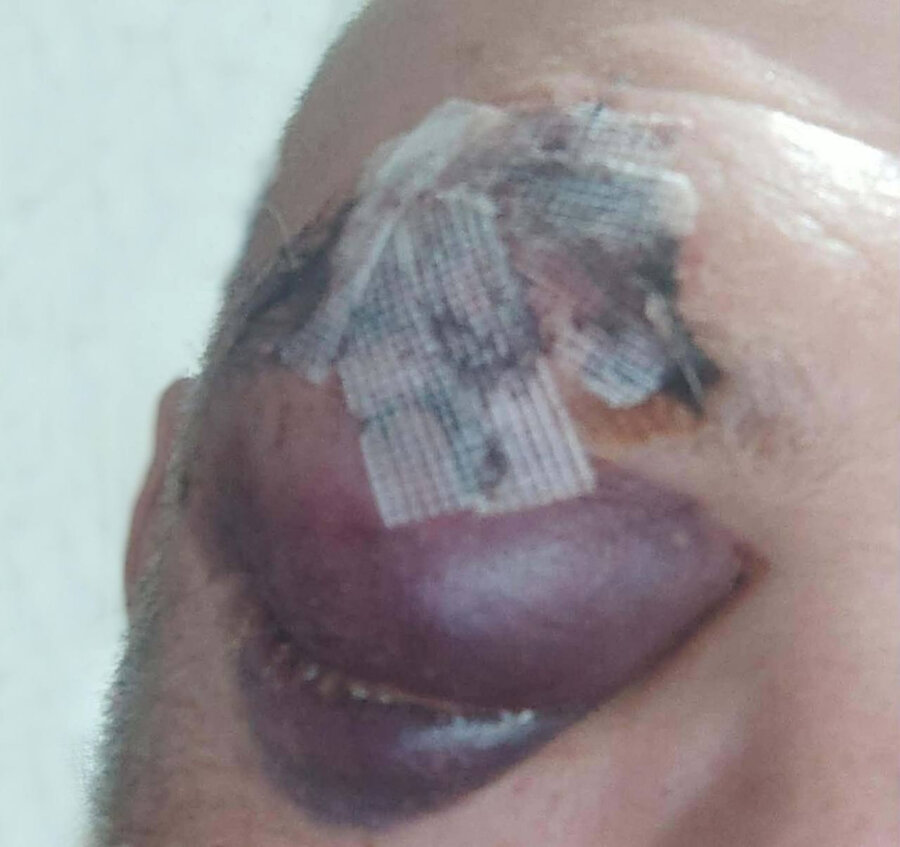 Πάτρα: Ζήτησε 20 ευρώ δανεικά από τον γείτονά του, δεν του τα έδωσε και τον ξυλοκόπησε