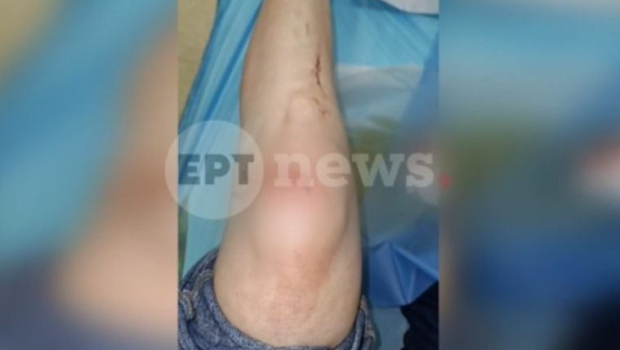 Πάτρα: Συγκλονίζει η γυναίκα που δέχτηκε άγρια επίθεση - «Έχω κατάγματα και μώλωπες»