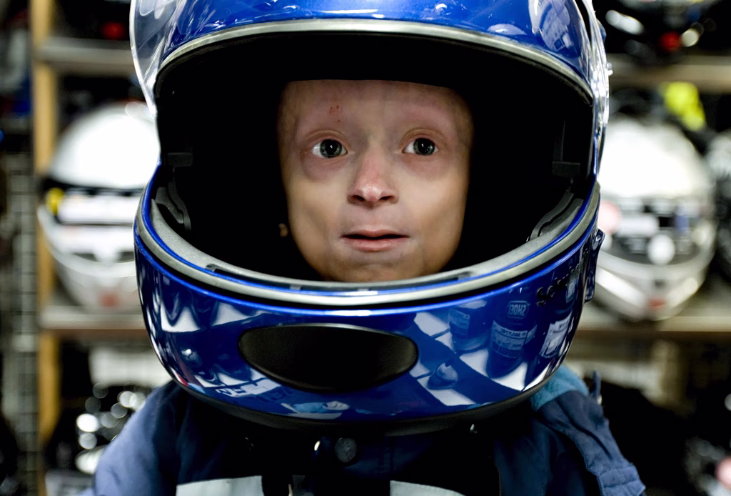 progeria